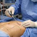 Liposuction Nedir? Diyetle Gitmeyen Yağlardan Kurtulmanın En Etkili Yolu